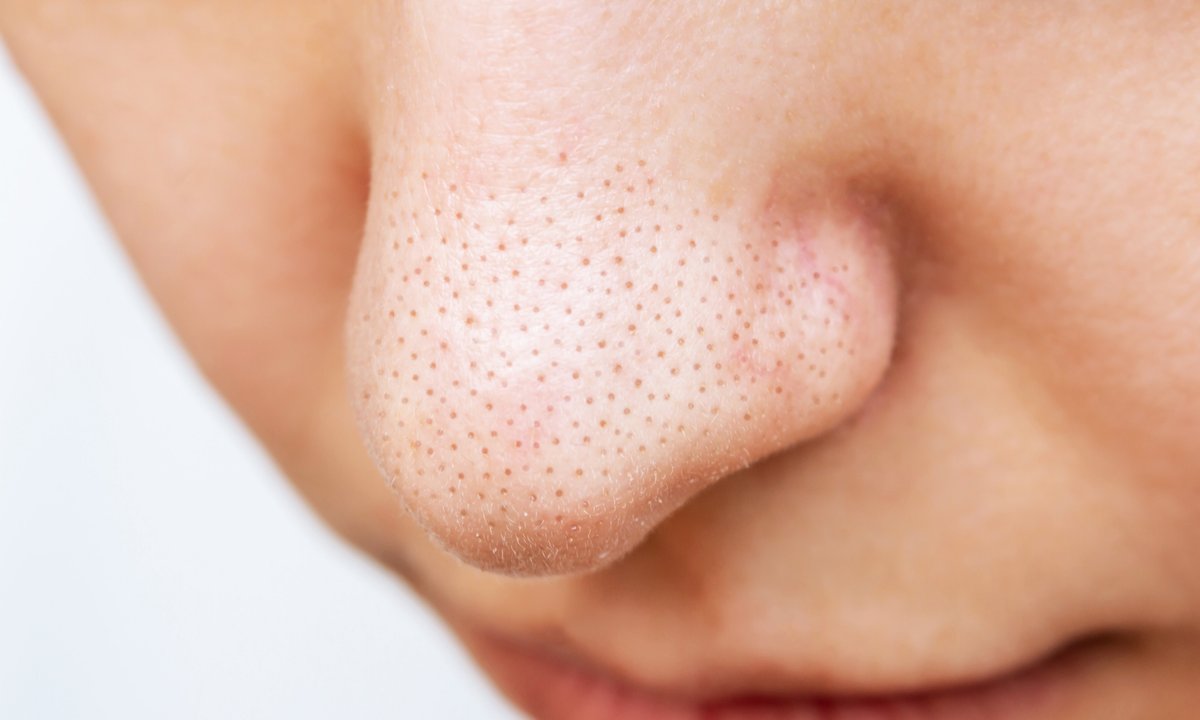 Wciąż robisz peeling, a wągry wracają? Pewnie zapominasz o tym składniku