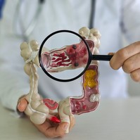 Vastagbélrák - ezeket a tüneteket sose hagyja figyelmen kívül