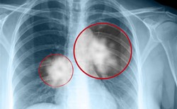Mamy postęp w leczeniu raka płuca, ale wiele jest jeszcze do zrobienia