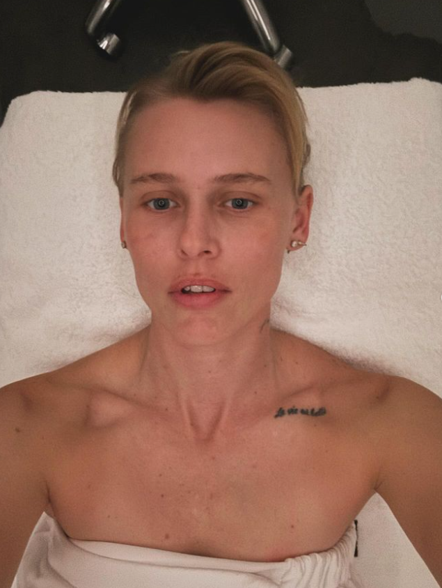 Lauren Wasser po vzniku syndrómu toxického šoku amputovali obe nohy.