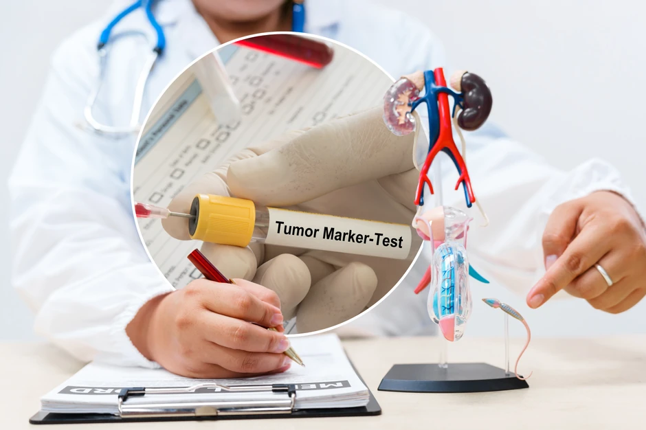 PSA tumor marker i rak prostate