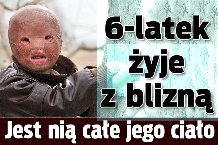 6-latek żyje z blizną. Jest nią całe jego ciało