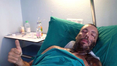 Horror: így néz ki a férfi, akit exbarátnője savval öntött le - 33 műtéten esett át - fotók (18+)