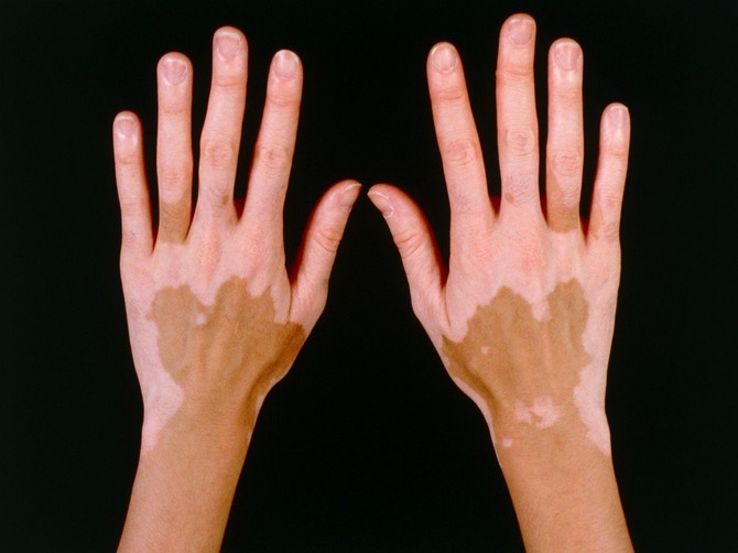 vitiligo