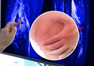 Osteosarkom se obično se razvija blizu krajeva kostiju, odnosno oko zglobova