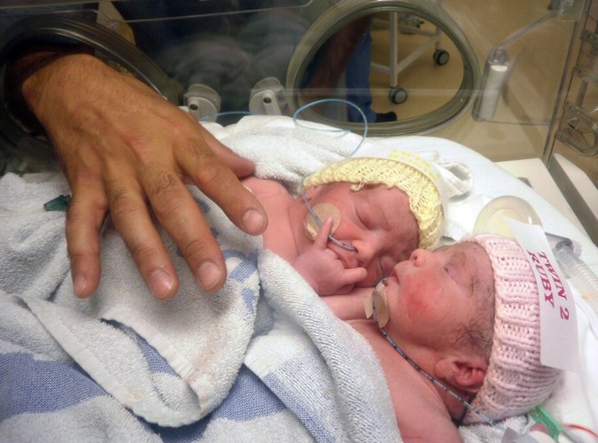 Bliźniaczki syjamskie