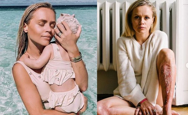 Blogerka Anna Skura oblana wrzątkiem przez swoją córkę. Pokazała straszne blizny po oparzeniu