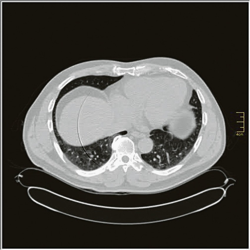 Rana faza (0. do 4. dan) - pojedinačne GGO, neka crazy paving, nizak skor