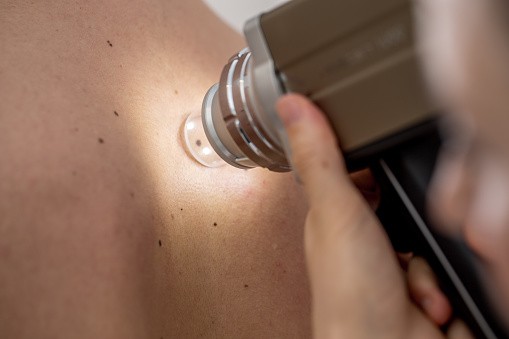 A rendszeres, évente történő anyajegyszűrés elengedhetetlen mindenkinek, akinek van anyajegye, a veszélyeztettetek esetében gyakrabban kell kivizsgálásra menni. 