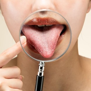 A nyelvrák első jelei, amiket szinte mindenki félreért