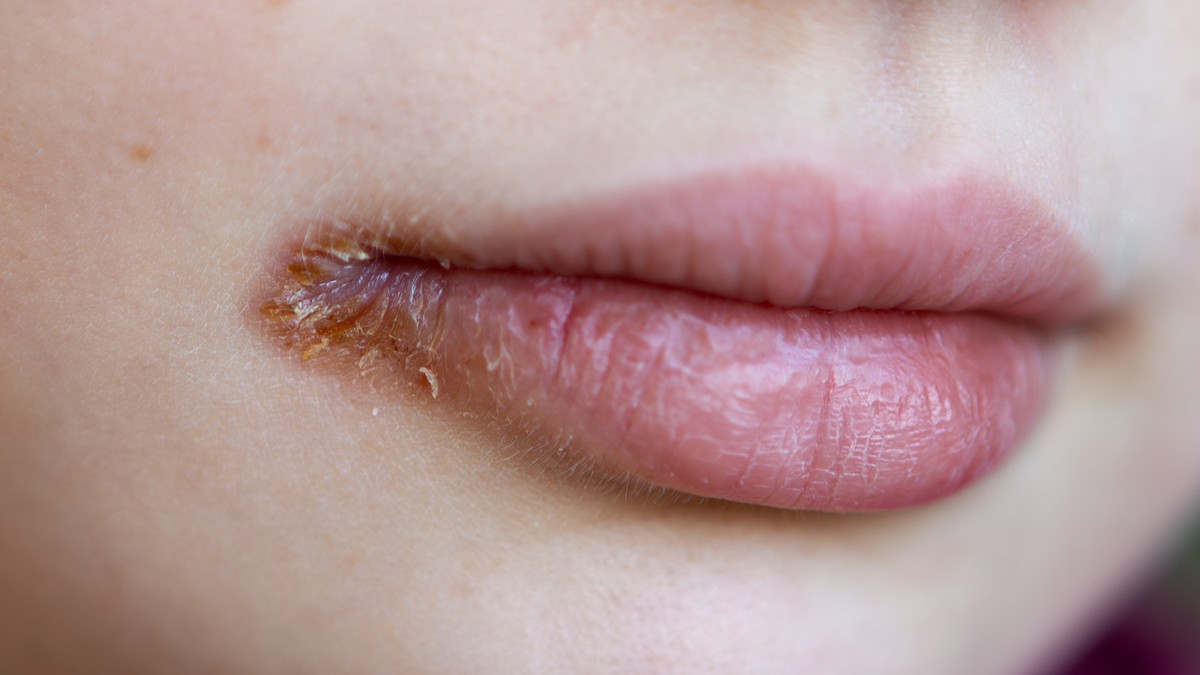 Žvale su ograničene na uglove usta i ne proizvode plikove 