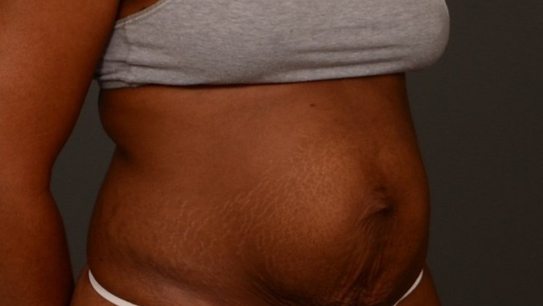 All about postpartum diastasis recti and how to get rid of it [Credit: The Birth Hour]