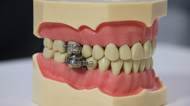 Fogsorba épített mágnessel érnék el a fogyást az embereknél / Fotó: Profimedia