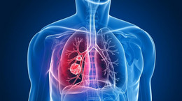 Chorzy na raka płuc mogą żyć dłużej