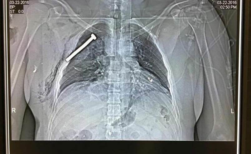 Zdjęcie rentgenowskie ofiary zamachów w Brukseli wykonane w wojskowym szpitalu w Neder-over-Heembeek. Na fotografii widać śrubę wbitą w klatkę piersiową rannego pacjenta