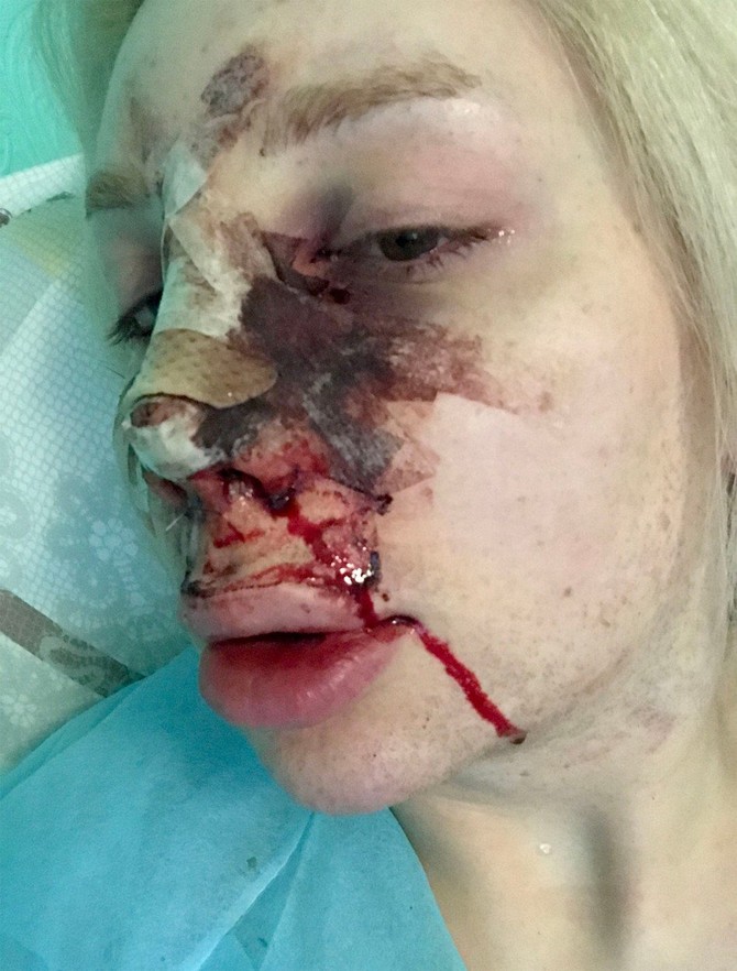 Ivana usred jednog od mnogobrojnih zahvata
