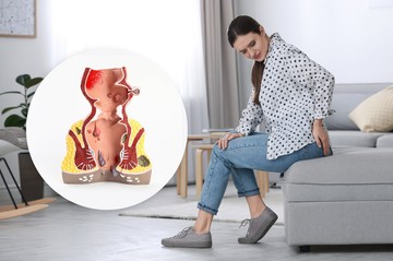 Előrehaladott aranyér: tünetek, amik már a 4. stádiumra utalnak