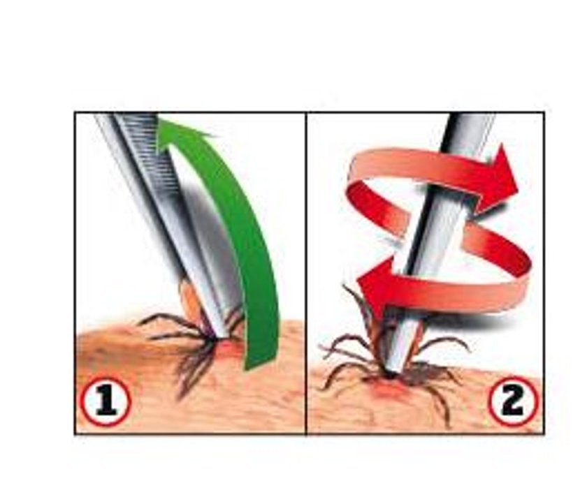Żeby bezpiecznie usunąć kleszcza trzeba użyć pęsety, pompki lub na przykład karty (są dostępne aptekach). Wyciągnij go ruchem po łuku zgodnym z kątem wkłucia (1). Nie wykręcaj kleszcza! (2) – to niebezpieczny mit 