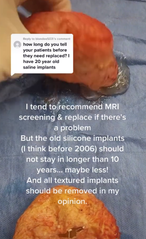 Pacientke vyoperovali 35 rokov staré silikóny. 