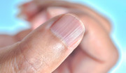 Choroby paznokci - grzybica, onycholiza, zanokcica. Co niszczy płytkę paznokci?