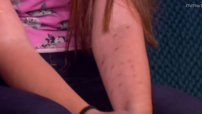 Dezodorral égette a karját a 12 éves kislány egy új trend miatt - videó