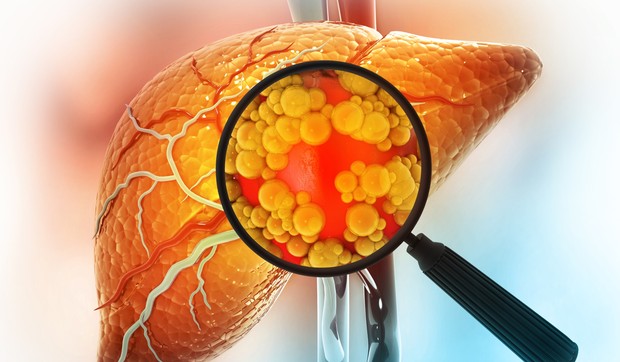 Metabolička bolest jetre je često povezana sa viškom kilograma 