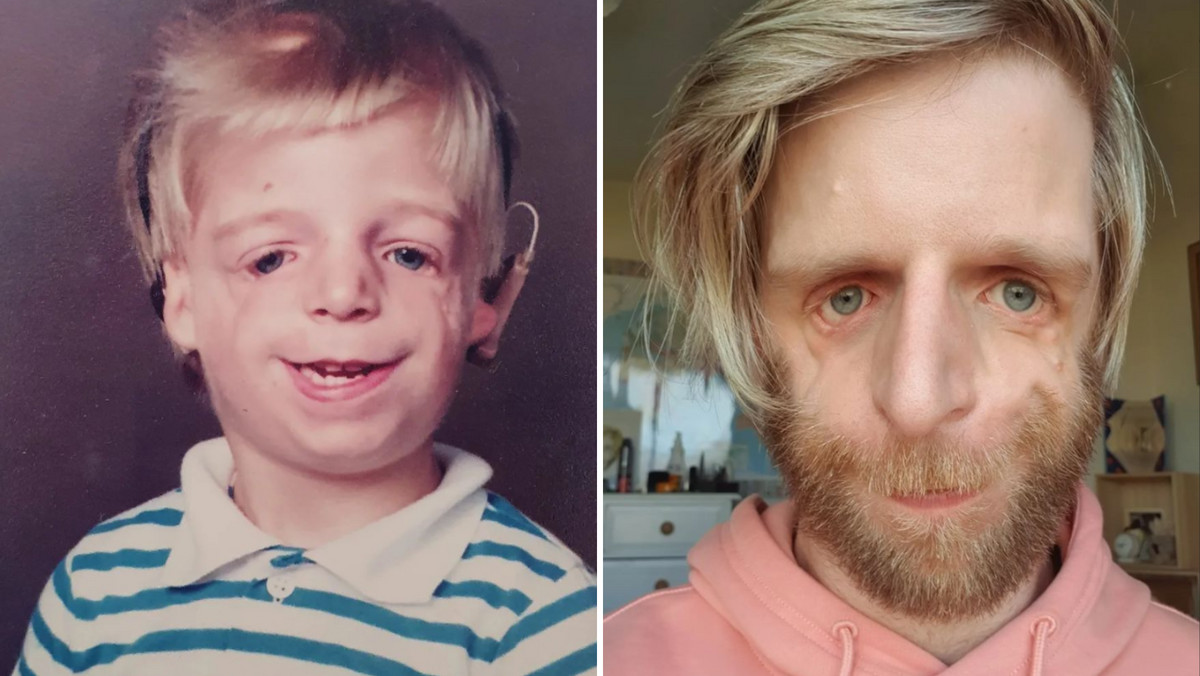 Urodził się ze zdeformowaną twarzą. "Rodzice porzucili mnie po 36 godzinach"