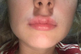 Beograđanka je mislila da ima herpes jer joj je pao imunitet: "Kad mi je doktor postavio ovo pitanje od muke sam viknula - NISAM, MAJKE MI!"