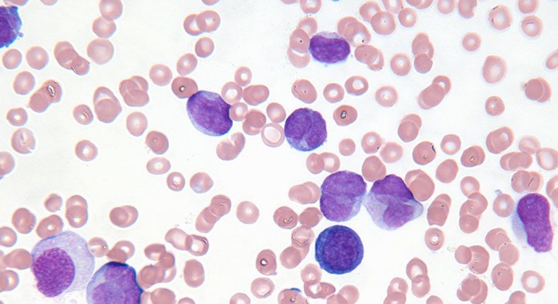 Would You Be Able To Spot These 7 Symptoms Of Leukemia?