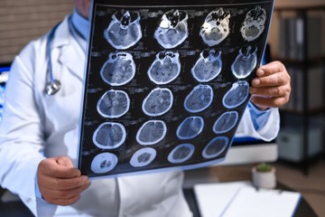 Nem javasolják az EU-ban az Alzheimer-kór elleni gyógyszer forgalomba hozatalát