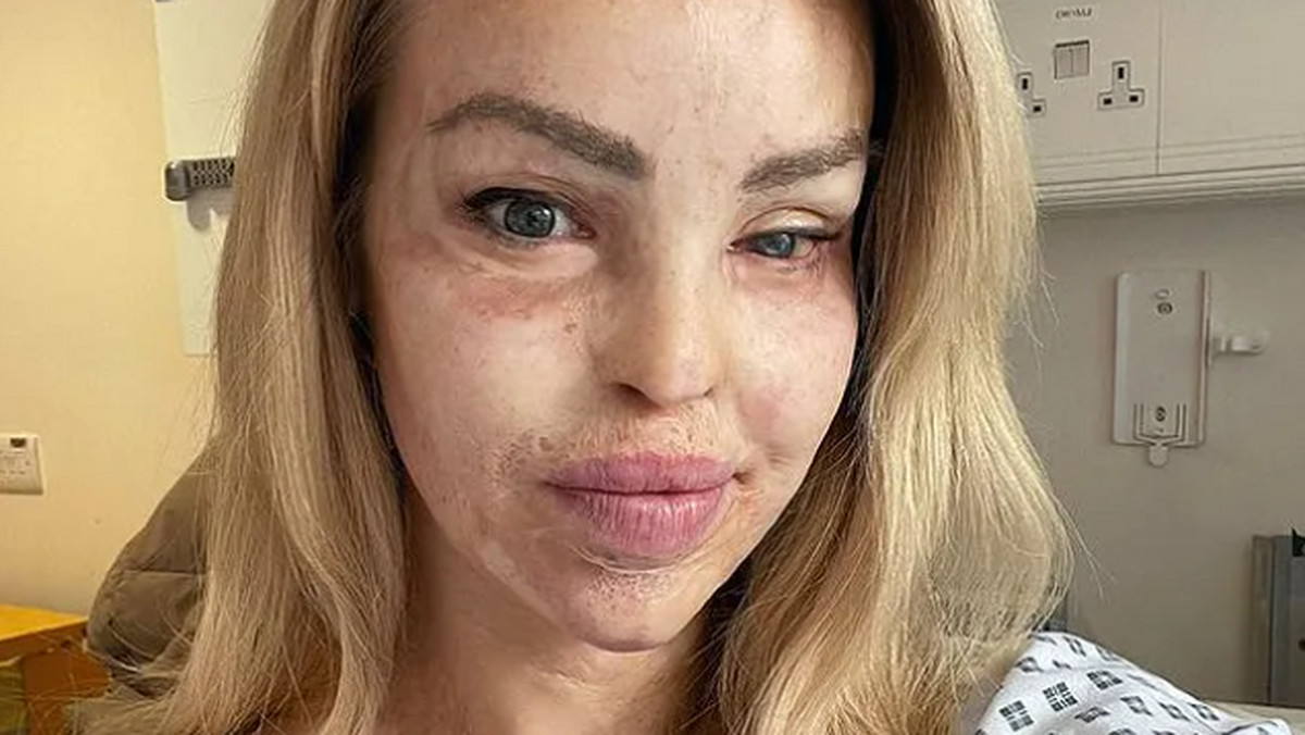 Katie Piper została zgwałcona, a potem oblana kwasem. "Czułam, jak moja twarz odpada"