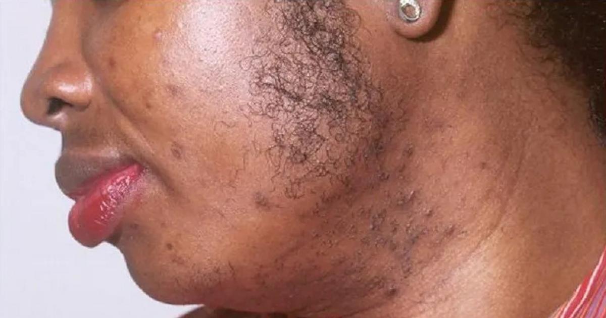Découverte : Pourquoi certaines femmes ont des poils au menton ? | Pulse  Côte d'Ivoire