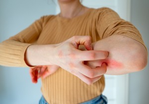 Češanje svraba može da dovede do rana, krvarenja i infekcija 