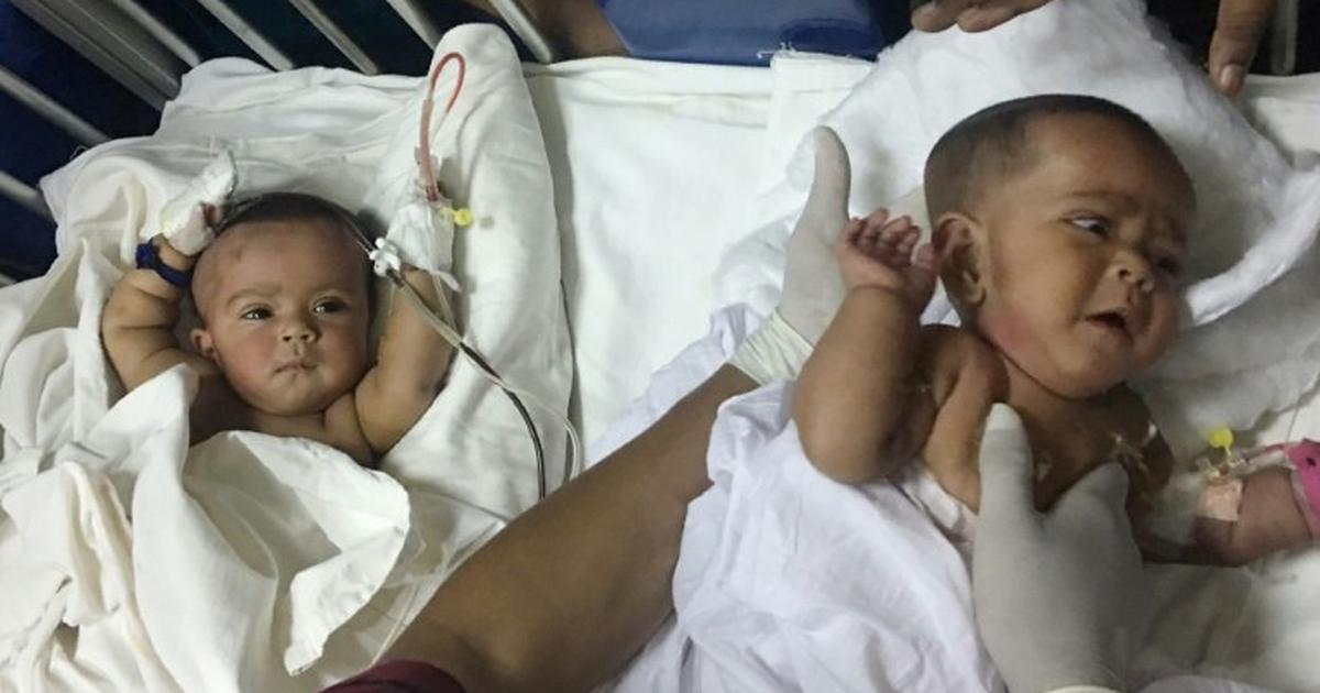 Conjoined Twins Separated In Rare Surgery Pulselive Kenya