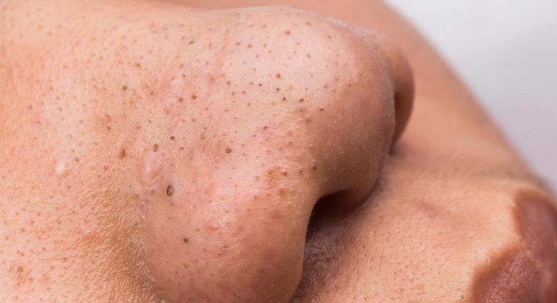 Beauty tips: Safe and effective ways to remove deep blackheads 