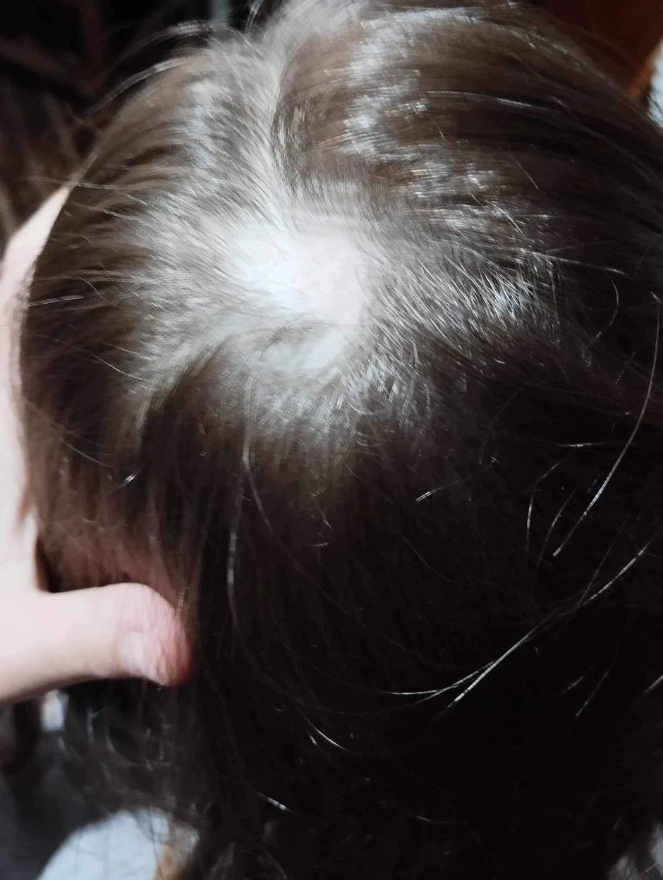 Otac je devojčici iščupao kosu