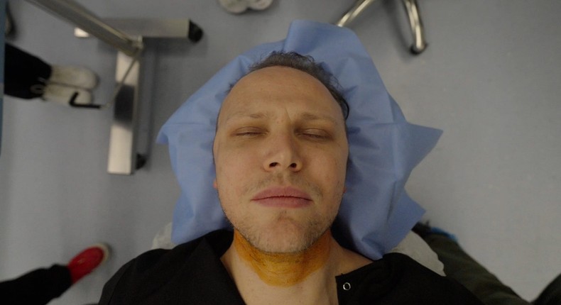 Spencer Macnaughton in the operating room in Istanbul, Turkey, ready for his hair transplant.Kenny Wassus/Business Insider