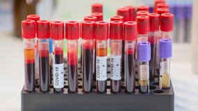 Naukowcy odkryli anomalię we krwi osób z COVID-19. Może tłumaczyć przewlekłe objawy