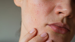 Pięć kroków w pielęgnacji suchej skóry