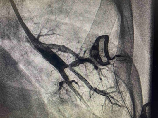 Pulmonalna balon angioplastika