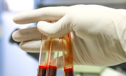 Jeden test krwi pozwala wykryć 14 nowotworów