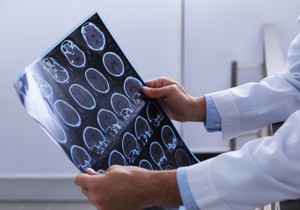 Multipla skleroza (MS) je zapaljenska autoimuna bolest koja pogađa centralni nervni sistem