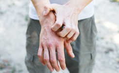 Eksperci: Chorzy na atopowe zapalenie skóry potrzebują terapii biologicznej