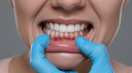 Jak objawiają się odsłonięte szyjki zębowe? Dentystka tłumaczy