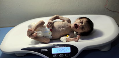 Przerażające zdjęcia zagłodzonego niemowlęcia w Syrii
