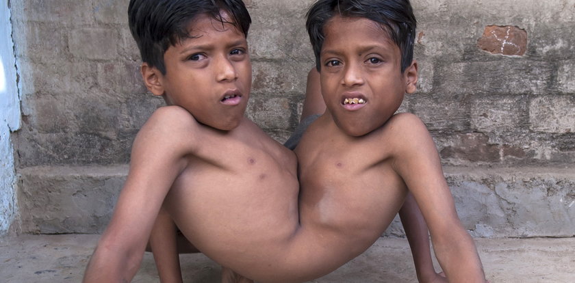 Niezwykłe życie bliźniaków syjamskich z Indii