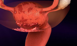 Na endometriozę cierpi niemal 167 mln kobiet. Nowe badania mogą pomóc w leczeniu