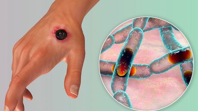 Enugu Govt advises residents not to panic over Anthrax outbreak [shutterstock]