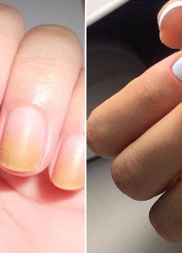 Желтые ногти после лака. Желтые ногти после лака. Желтые ногти после лака. Пожелтение ногтевой пластины. Желтые ногти после лака.