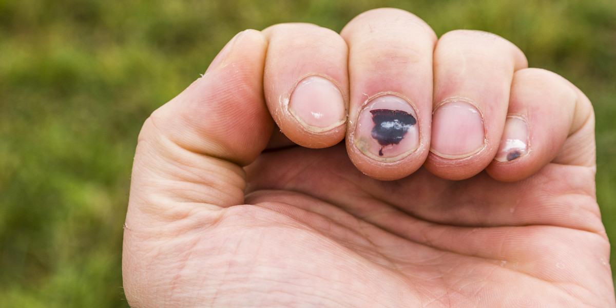 Zdrowe paznokcie powinny być gładkie i mieć lekko różowawy kolor. Czarne plamki na paznokciach mogą być skutkiem urazu, stosowania leków czy oddziaływania środków chemicznych. Z kolei czarne plamki pod płytką paznokcia mogą być odmianą czerniaka złośliwego